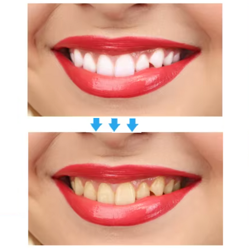 Bandes Blanchiment Dentaire (box1)